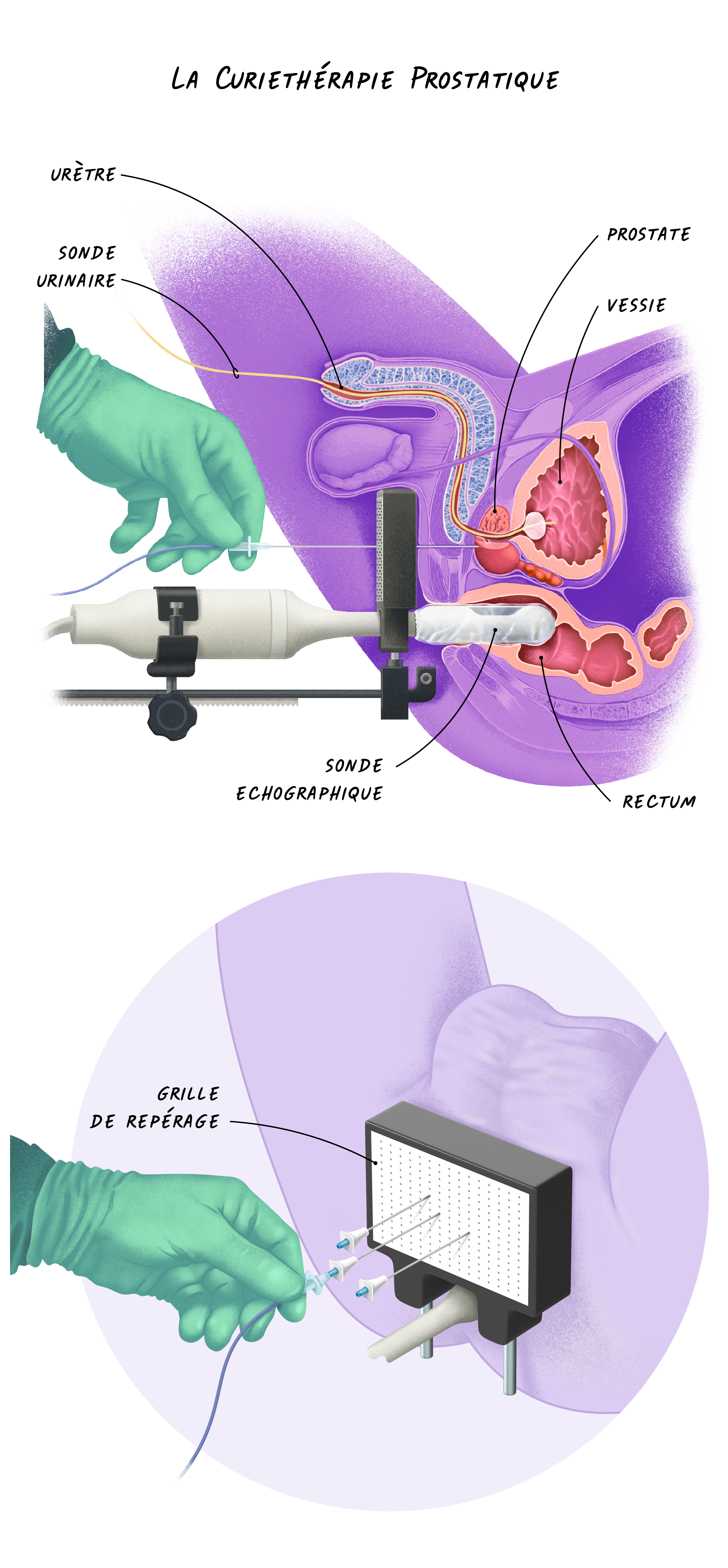 Illustration de la curiethérapie prostatique
