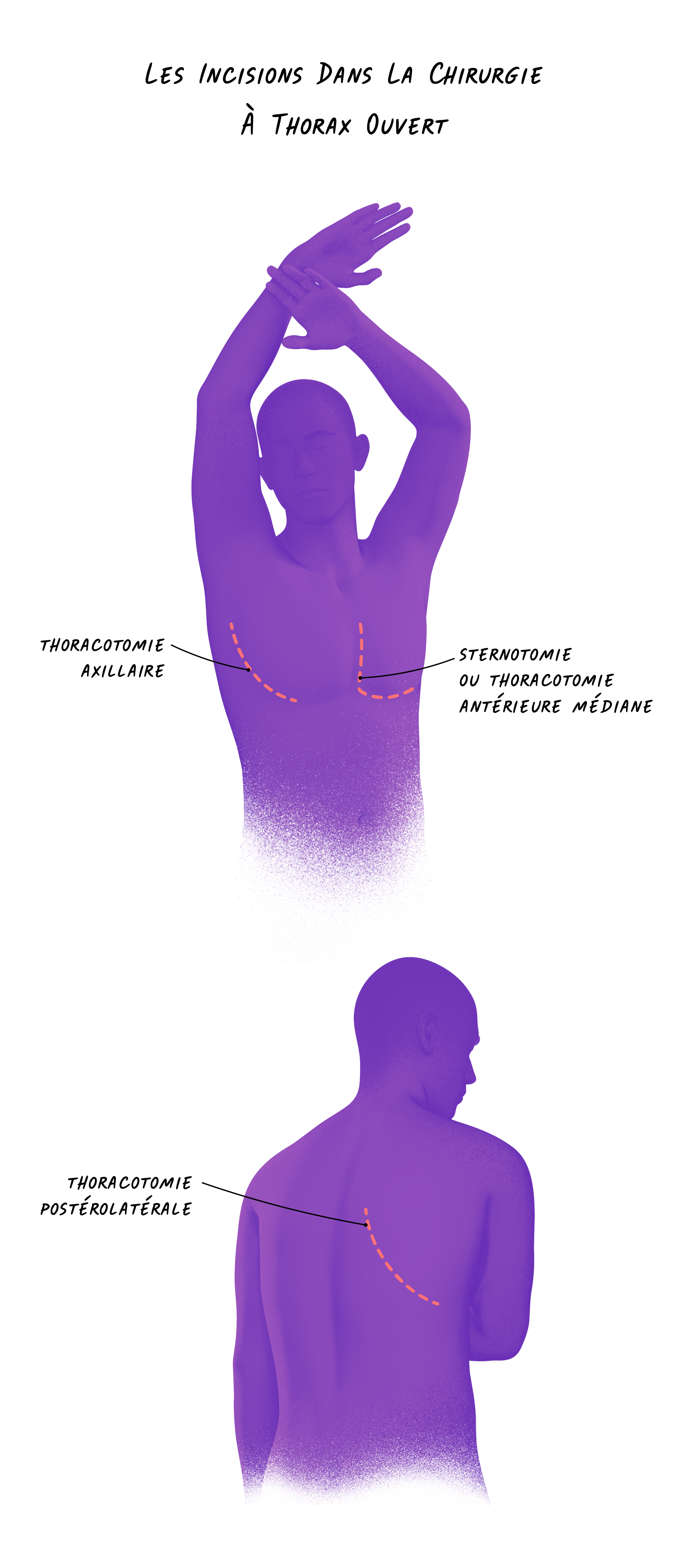 Illustration des incisions à thorax ouvert