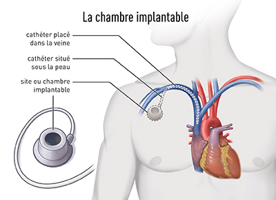 La chambre implantable