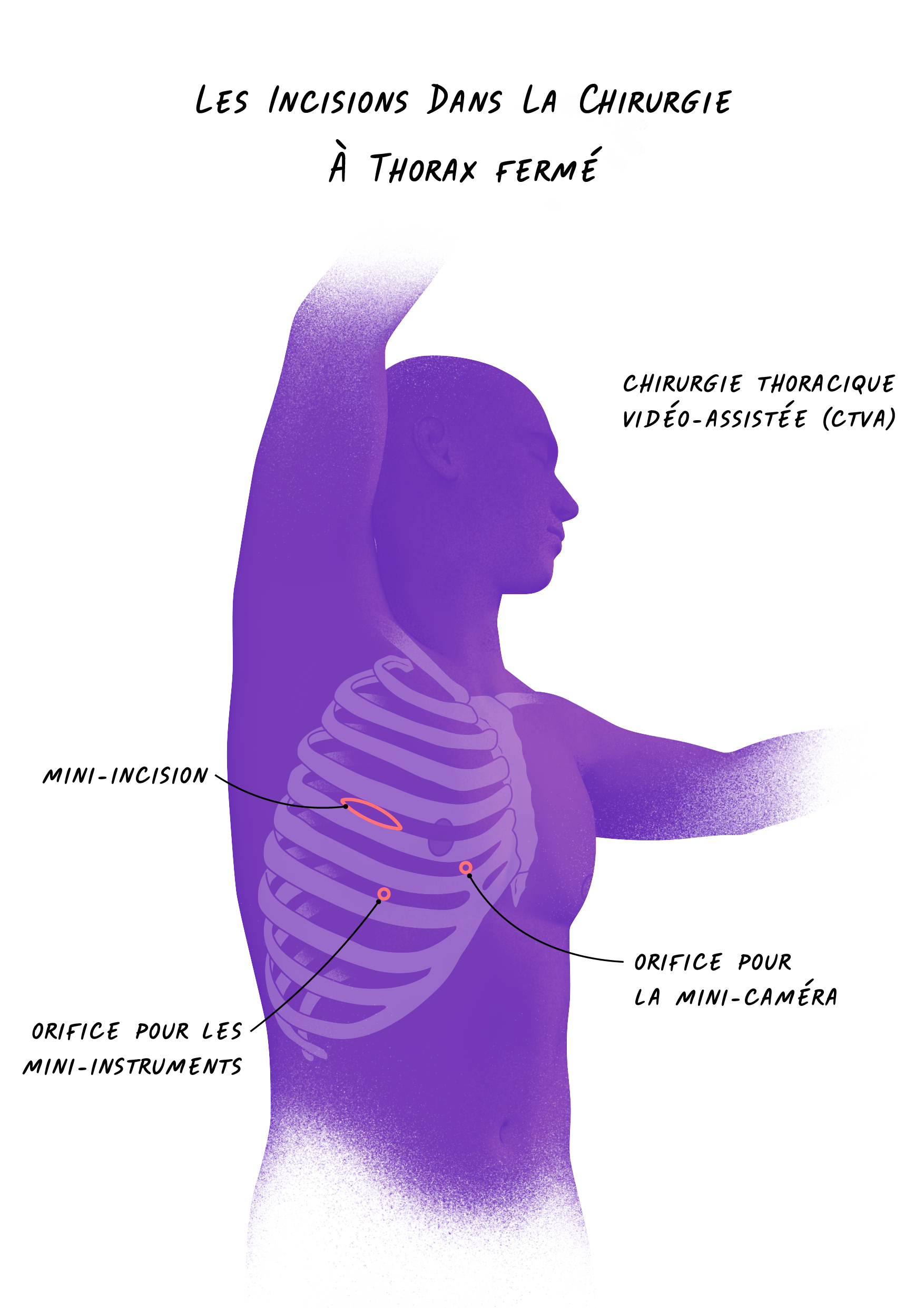Illustration des incisions à thorax fermé