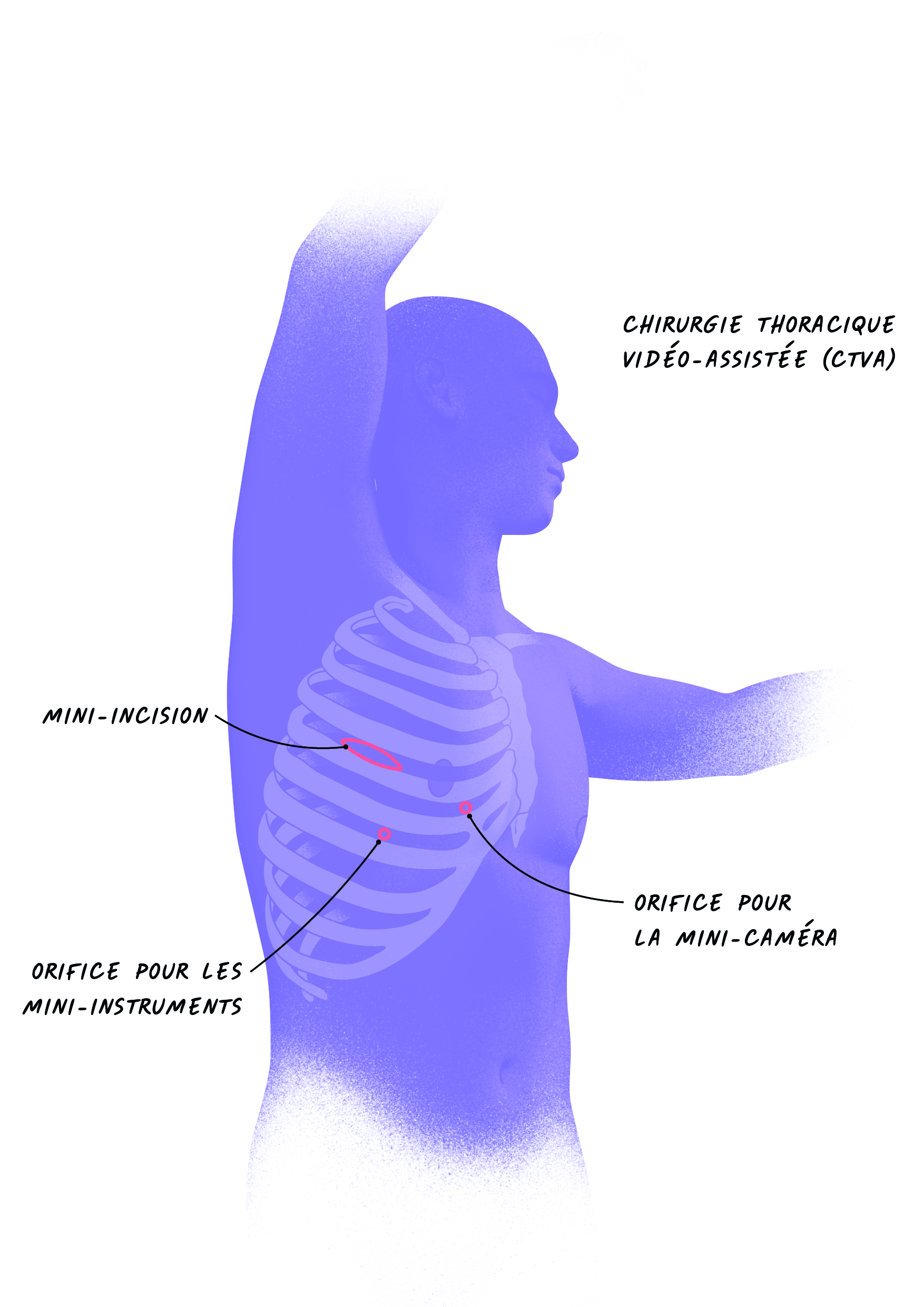 Illustration des incisions &agrave; thorax ferm&eacute;