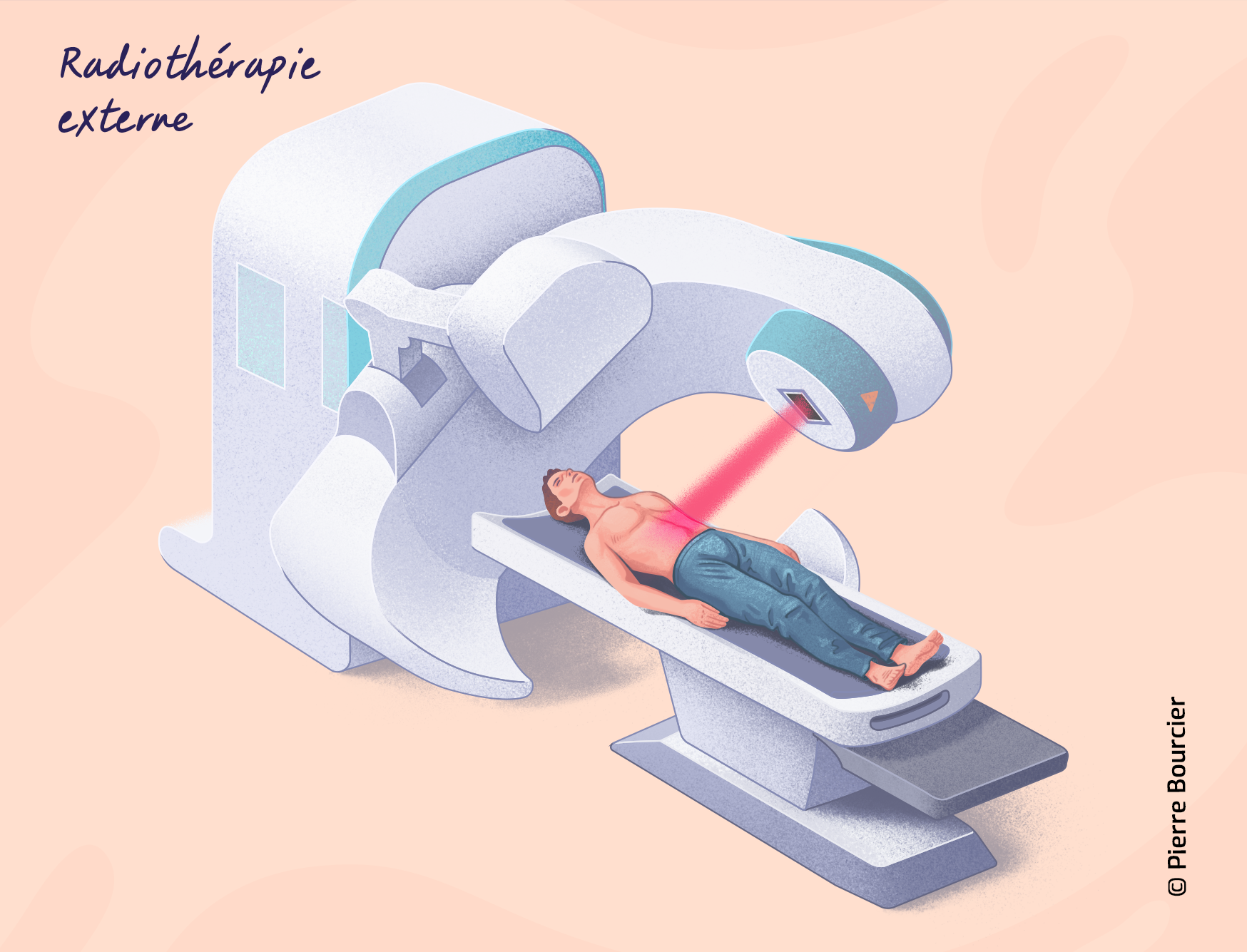 Cancers Du Rectum La Radioth rapie